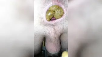 Shit Is So Hard That It Tears Bro's Asshole